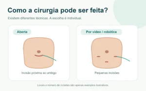Comparação entre cirurgia aberta e cirurgia por vídeo ou robótica para hérnia umbilical