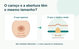Diferença entre o volume visível da hérnia umbilical e o tamanho real da abertura na parede abdominal