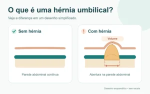 Esquema comparando parede abdominal normal e parede abdominal com hérnia umbilical